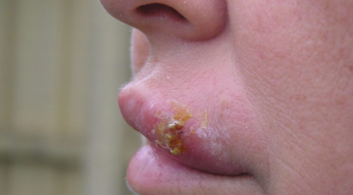 Interpretare vis în care apar bube Interpretare vis in care apar bube