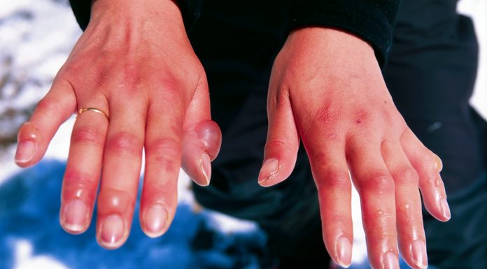 Interpretare vis in care apar degeraturi