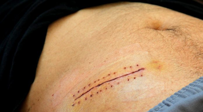 Interpretare vis in care apare apendicita