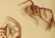 Interpretare vis in care apare boala venerica