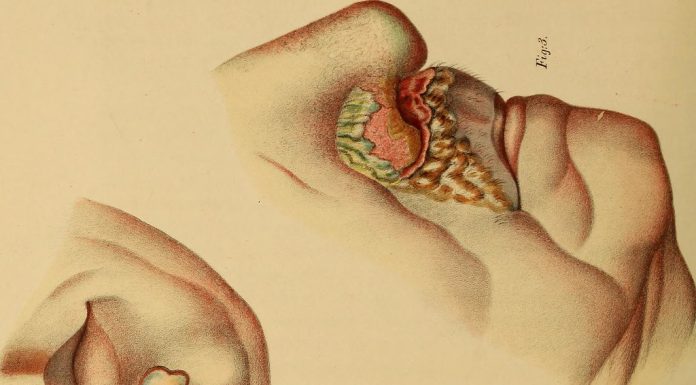 Interpretare vis in care apare boala venerica