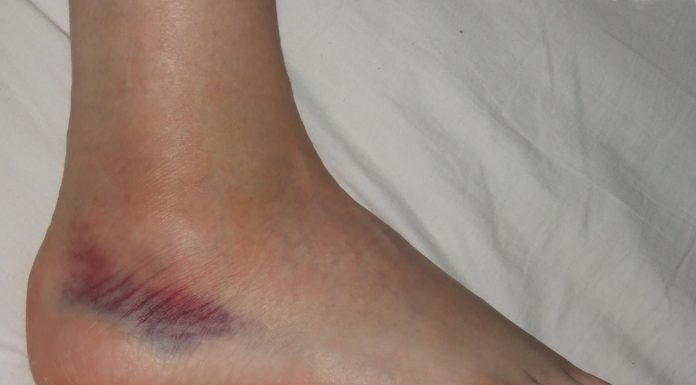 Interpretare vis in care apare entorsa