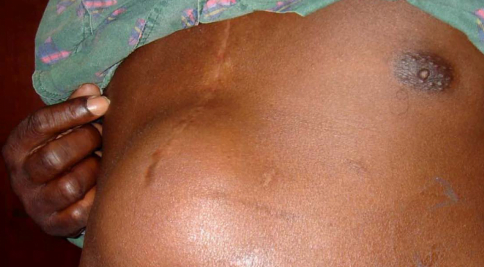 Interpretare vis in care apare hernie Interpretare vis in care apare hernie