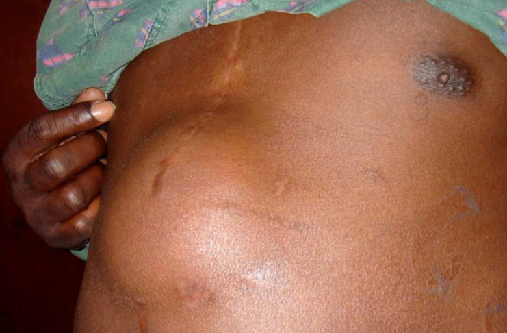 Interpretare vis in care apare hernie