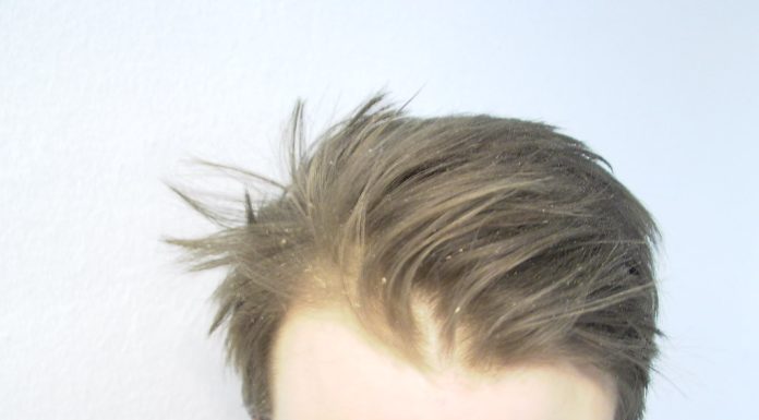 Interpretare vis în care apare mătreață