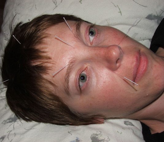 Interpretare vis in care apare o acupunctura