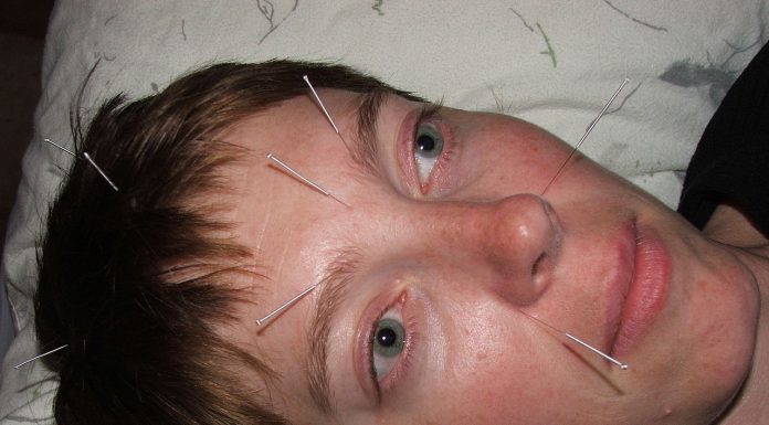 Interpretare vis in care apare o acupunctura