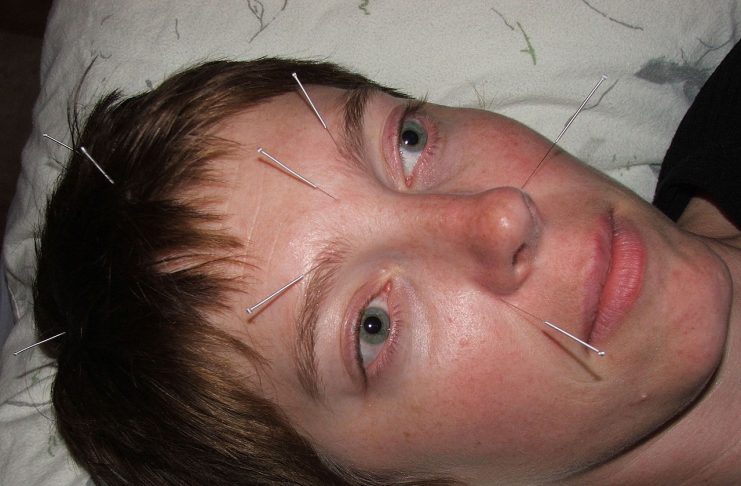 Interpretare vis în care apare o acupunctură Interpretare vis in care apare o acupunctura