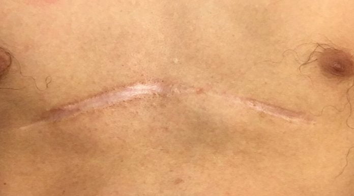 Interpretare vis în care apare o cicatrice Interpretare vis in care apare o cicatrice