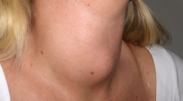 Interpretare vis in care apare o gusa