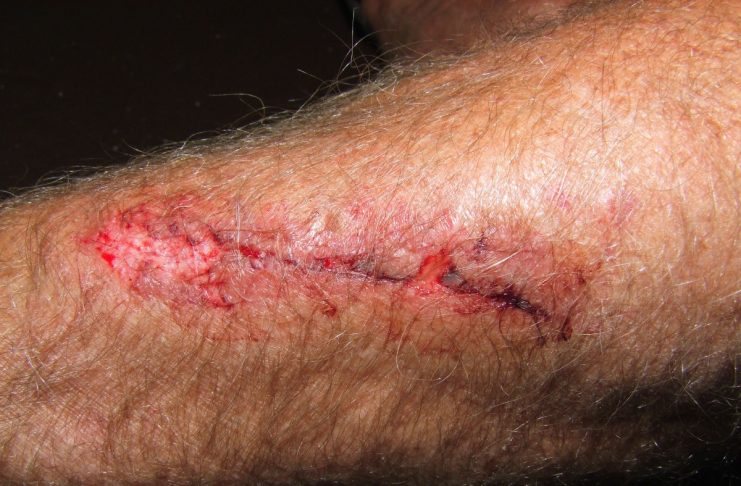 Interpretare vis în care apare o rană/ rănit/ rănire Interpretare vis in care apare o rana ranit ranire