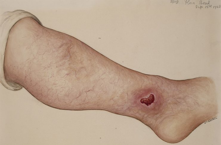 Interpretare vis in care apare ulcer