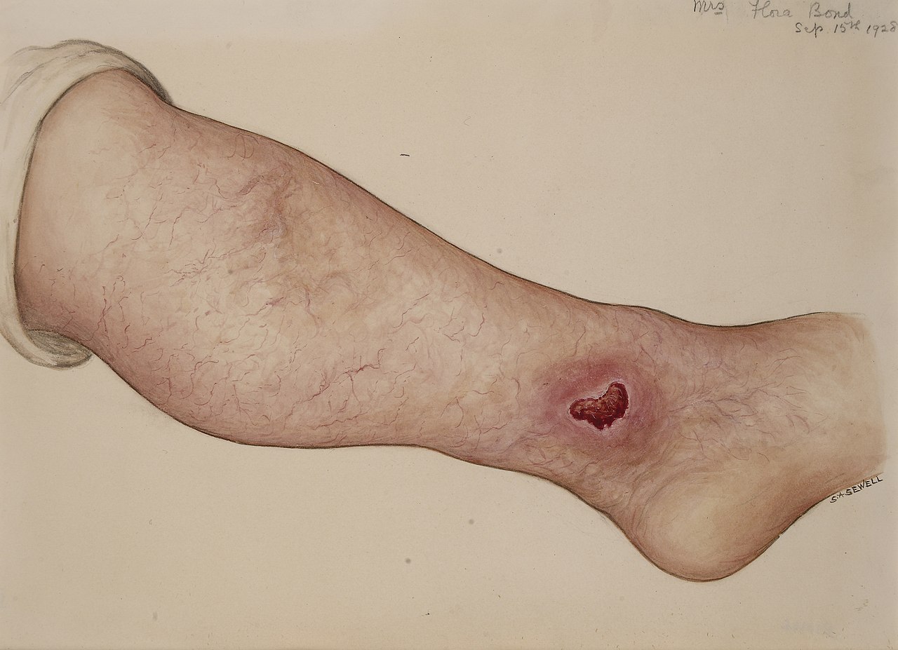Interpretare vis in care apare ulcer