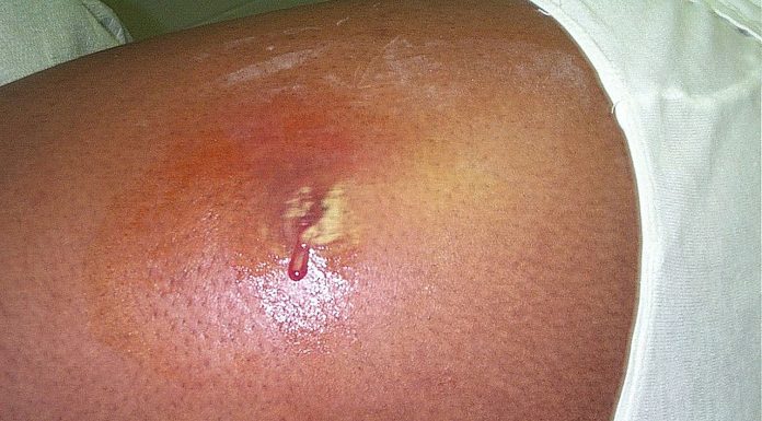 Interpretare vis in care apare un abces