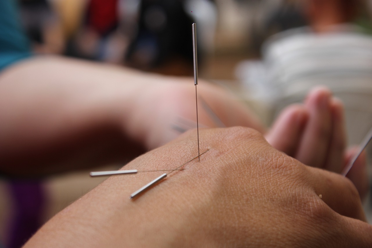 acupunctura