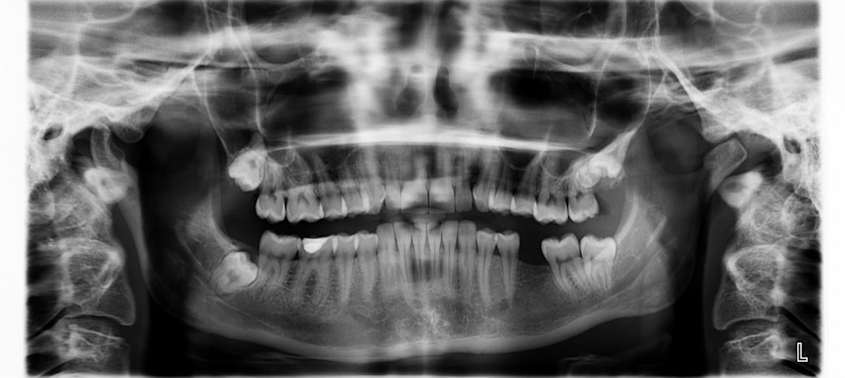 radiografie dentara