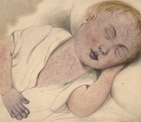 Interpretare vis in care copilul tau se naste cu malformatii