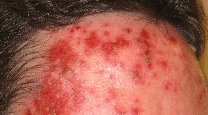 Interpretare vis in care esti plin cu cosuri pe fata