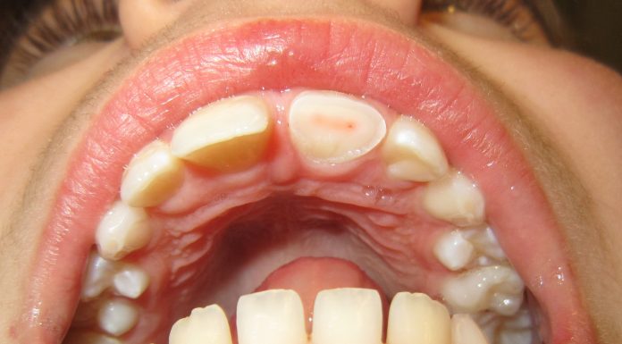 Interpretare vis in care ti se sfarma dintii