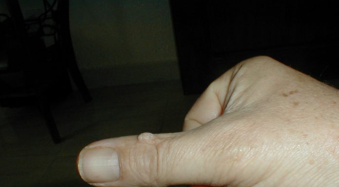 Interpretare vis in care iti vezi mainile pline cu negi