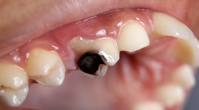 Interpretare vis în care vezi carii dentare