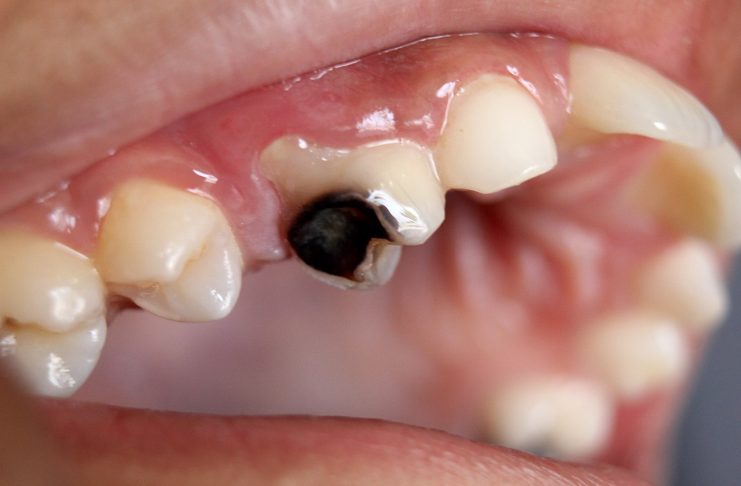 Interpretare vis în care vezi carii dentare